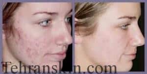 لایه برداری از پوست با لیزر لایه برداری از پوست با لیزر