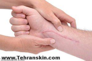 اسکار ناشی از جراحی چطور درمان کنیم؟ %D8%A7%D8%B3%DA%A9%D8%A7%D8%B1 300x200 - اسکار ناشی از جراحی چطور درمان کنیم؟