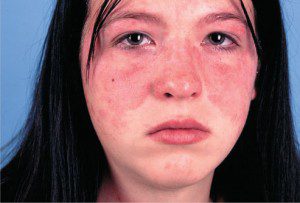 m-h_photo_of_systemic_lupus_erythematosus