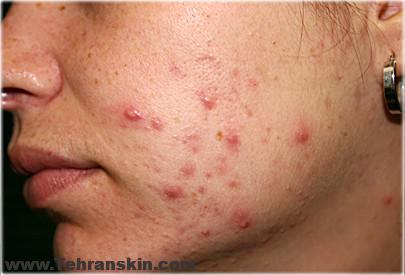 انواع آکنه و دلیل بروز آن