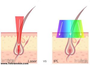 نکات لیزر موهای زائد در مقایسه با آی پی ال