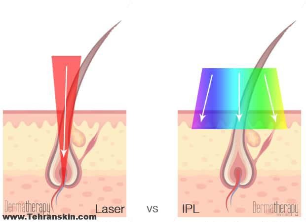 نکات لیزر موهای زائد در مقایسه با آی پی ال