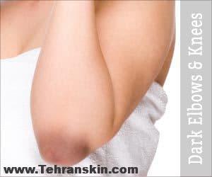 آرنج و زانوی تیره