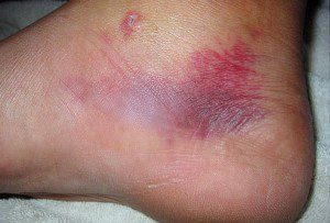 حساسیت به ماهی پهن