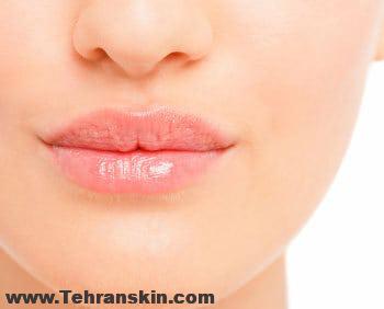 داشتن لب هایی زیبا با تزریق