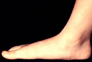 انحنای کف پا