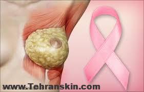 سرطان سینه