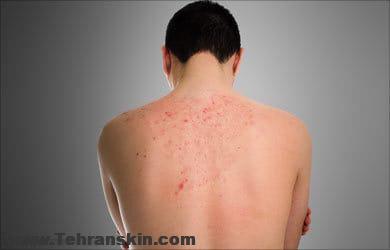 تا حالا توسط کک گزیده شده اید ؟ به نظرتان راه درمانش چیست؟