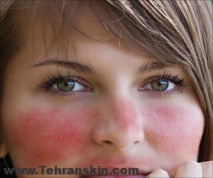 کرم جدید برای التهاب پوست و درمان روزاسه آ