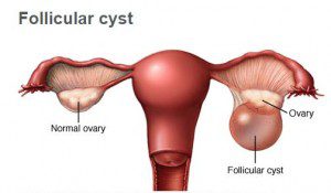 علل و علائم کیست های تخمدانی