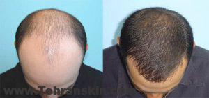 hair-transplant درمان ریزش مو