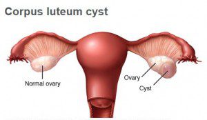 علل و علائم کیست های تخمدانی