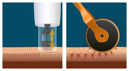میکرونیدلینگ چیست؟