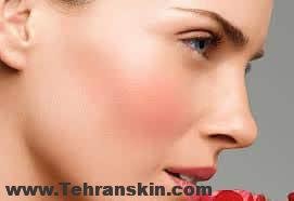 چطوری می توان گونه های گلگون داشته باشیم؟