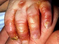 آکرودرماتیزیس