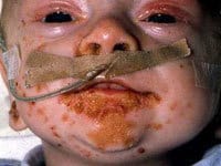 آکرودرماتیزیس