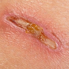 زخم های ناشی از شینگل یا زونا