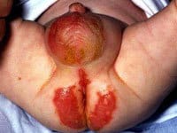 آکرودرماتیزیس