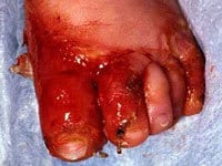 آکرودرماتیزیس