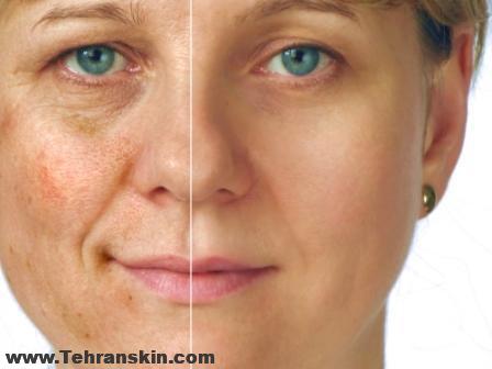 درمان هایپرپیگمانتاسیون