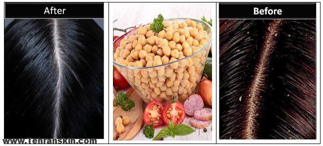 مواد مغذی برای مقابله با شوره سر