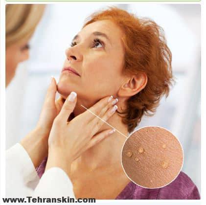 تگ های پوستی- skin tags