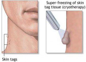 کرایو تراپی