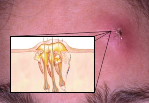 دمل یا آبسه پوست