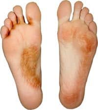 بیماری پای ورزشکاران- athlete’s foot