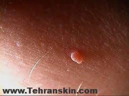 دلیل بروز تگ های پوستی و درمان آن
