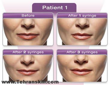 جوودرم چیست