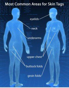 مناطقی که تگ های پوستی بروز می کنند