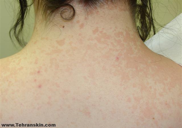 تینه آ ورسیکالر