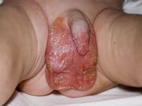 آکرودرماتیزیس