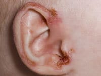 آکرودرماتیزیس