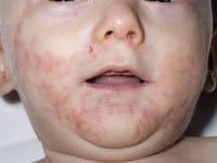 آکرودرماتیزیس