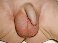 آکرودرماتیزیس