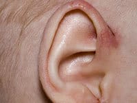 آکرودرماتیزیس