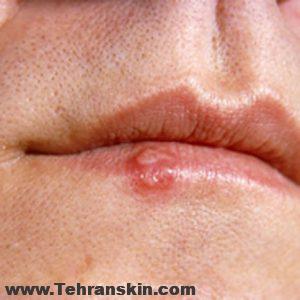 Herpes Cold Sore