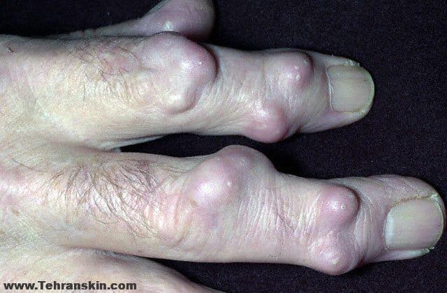 اسکلرودرمی