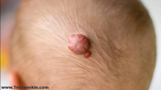 همه چیز در مورد همانژیوما