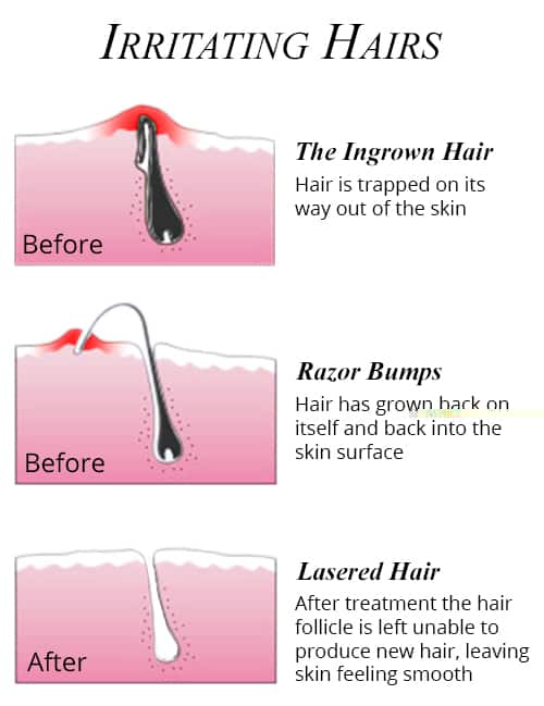موثرترین درمان برای موهای زیر پوستی