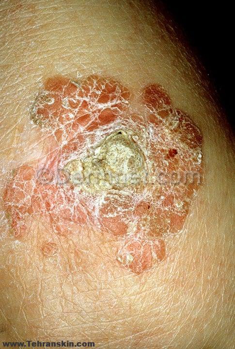 تشخیص و درمان بیماری بوون