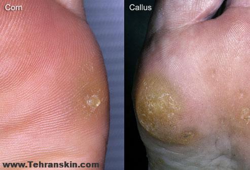 میخچه یا پینه