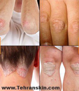پسوریازیس و انواع آن