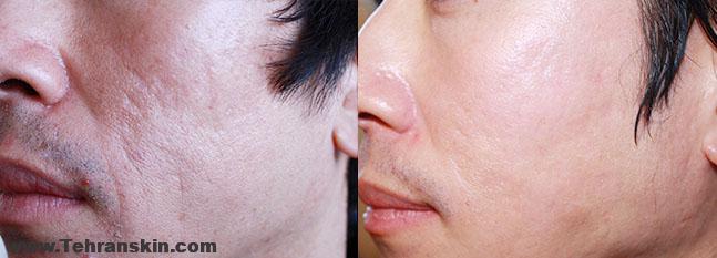 درمان جای جوش با ساب سیژن