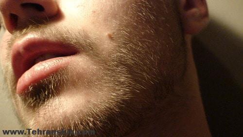 موی ولوس و موی ترمینال و تفاوت آن با موی سر