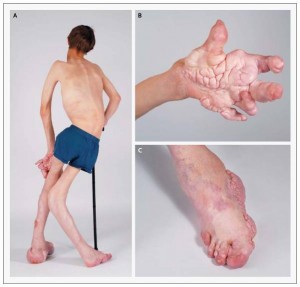 سندرم پروتئوس