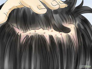 فولیکولیت مو