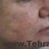 فتو دینامیک تراپی